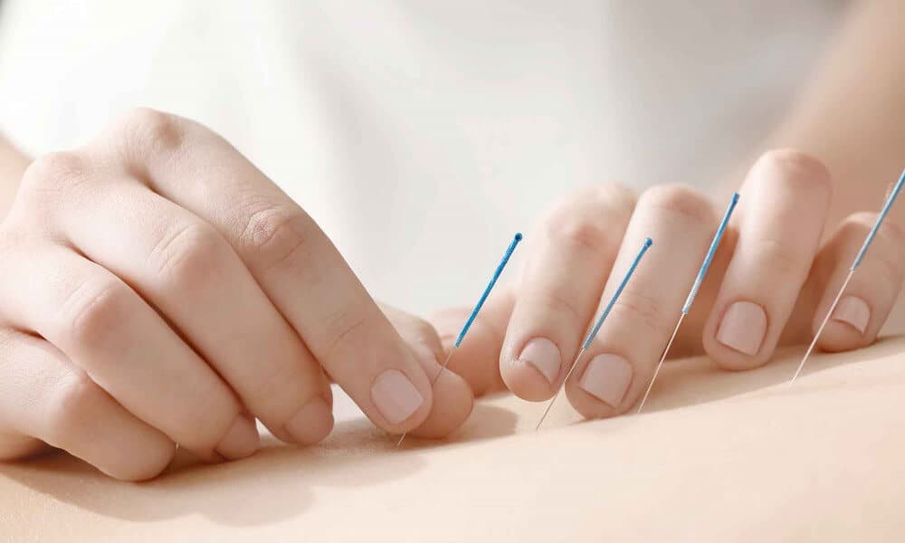 Acupuncture Therapy As Part Of Mountainside Luxury Detox Program