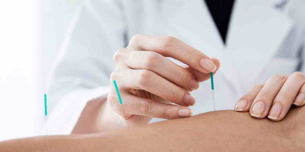 doctor placing acupuncture